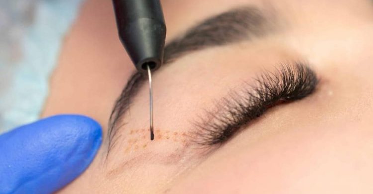 Eyelid surgery with laser