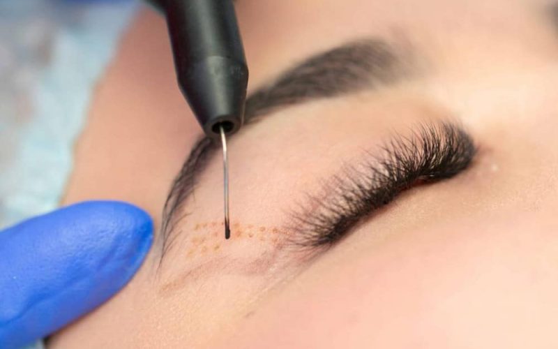 Eyelid surgery with laser