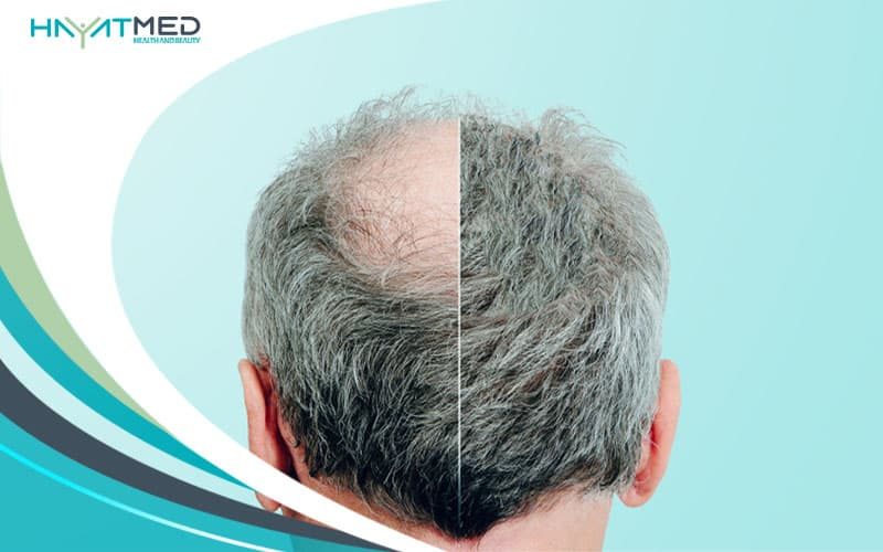 FUE Hair Transplant Growth new