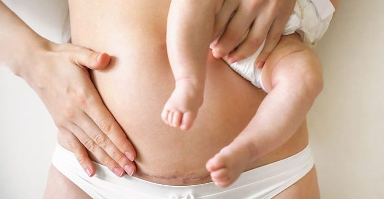 Liposuction Or Tummy Tuck After C Section 1