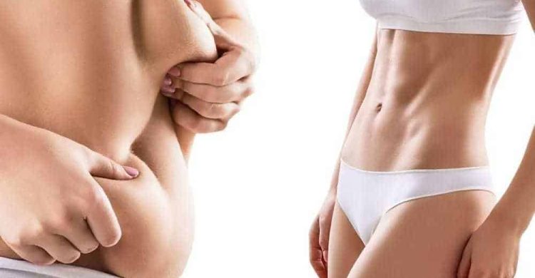 Liposuction on Arms and Back