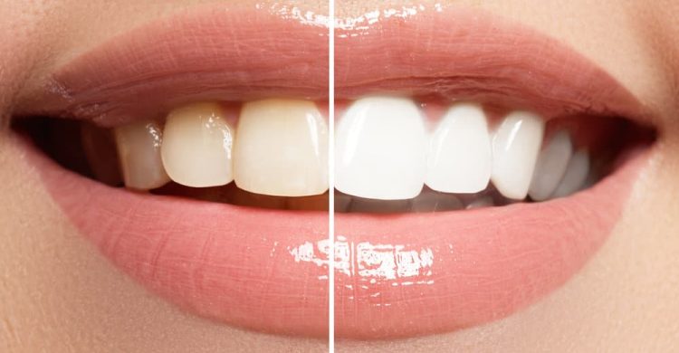 Teeth Whitening 121