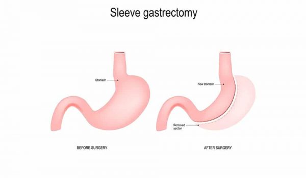 Gastric Sleeve Weight Loss