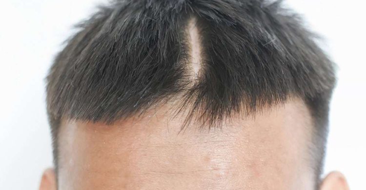 How to Get a Hair Transplant on a Scar
