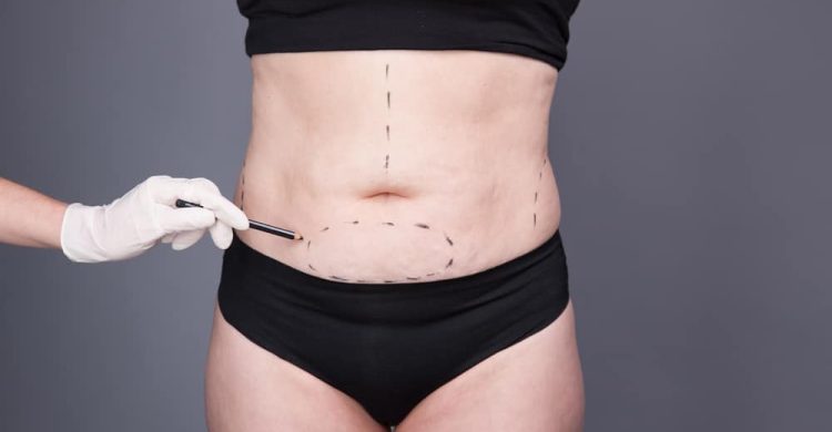 What is the cost of a tummy tuck