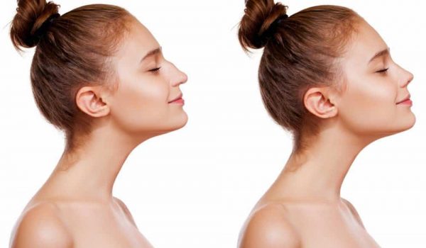 How Much Does The Average Rhinoplasty Cost?