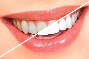 What Can I Eat After Teeth Whitening?